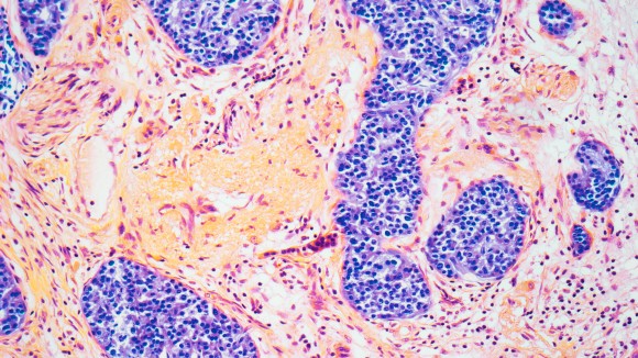 how does glp 1 cause pancreatitis The possible mechanisms of weight loss caused by GLP-1. GI, Reconciling GLP-1s and Pancreatitis