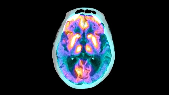 Sel Tanycytes: Kunci Menghapus Protein Tau dan Mencegah Alzheimer