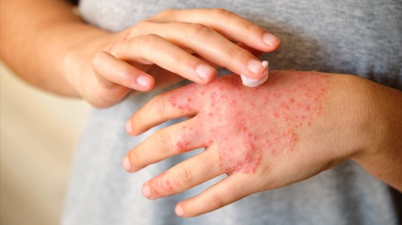 Bagaimana Stres Memicu Eksim: Penemuan Baru Jaringan Saraf dan Sel Imun