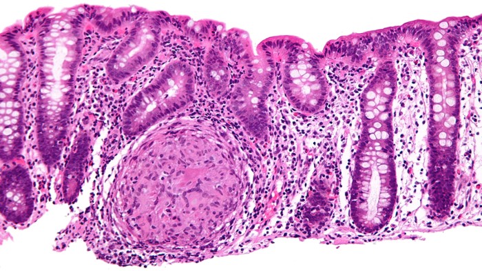 Crohn's colon sample