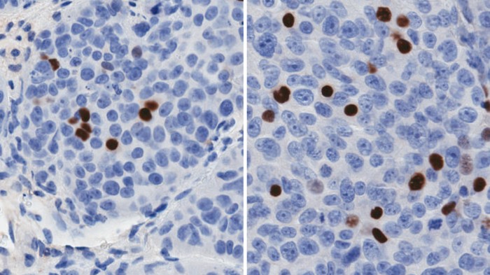 Immunostaining of cancer cells