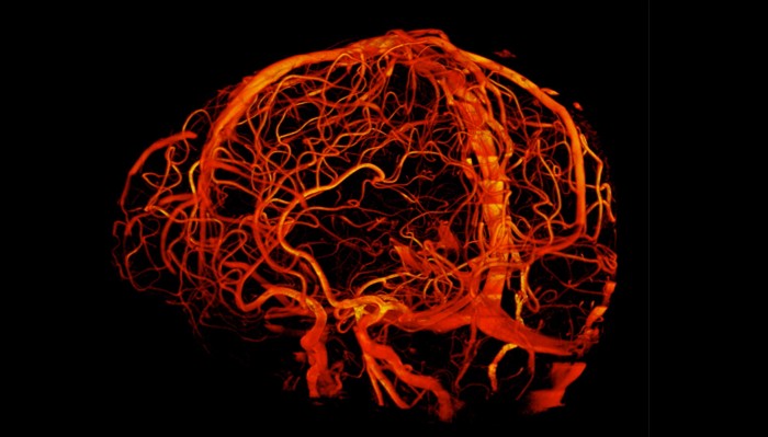 MRI scan of blood vessels in the brain
