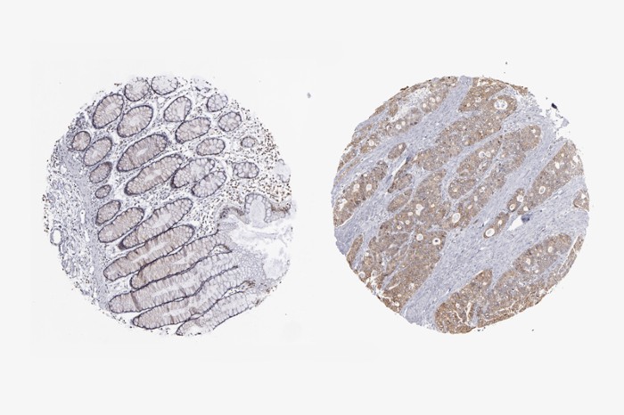 Microscopic images of colon tissue with cancer (right) and without cancer (left)
