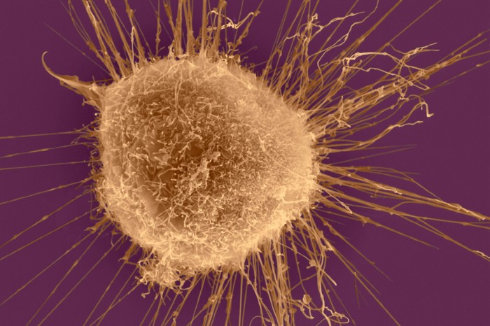 False-colour scanning electron micrograph of a breast cancer cell