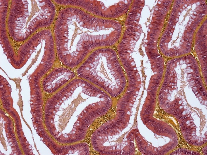 Metastatic lung cancer. Light micrograph of a section through bowel tissue showing a secondary (metastatic) tumour.