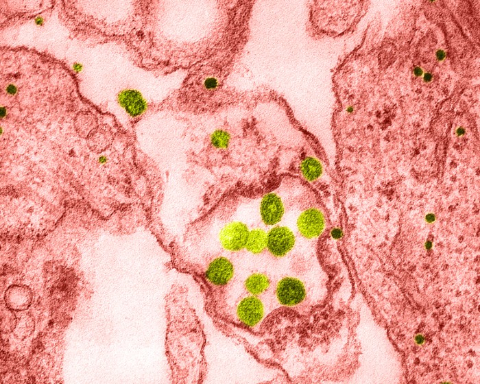 Colour enhanced transmission electron micrograph of human coronavirus, HCoV-229E
