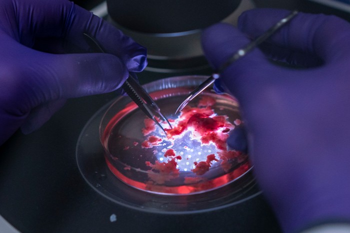 Close up of a brain tumour being dissected in a petri dish lit from beneath