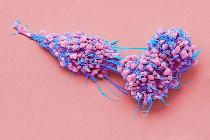 Coloured scanning electron micrograph of ovarian cancer cells