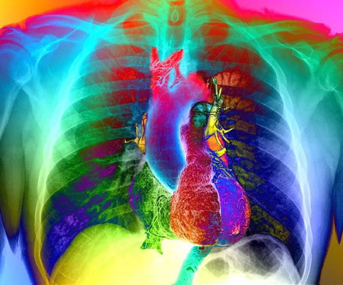Coloured frontal chest X-ray superimposed with a coloured 3D CT scan of the heart and its blood vessels in a healthy adult.