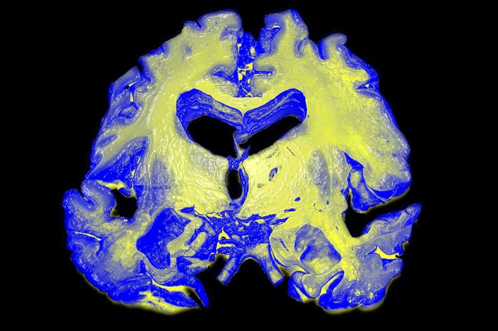 A coloured scan (blue and yellow) of a human brain showing physical signs of Alzheimer's disease.