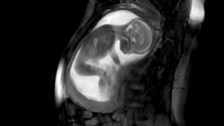 MRI of fetus