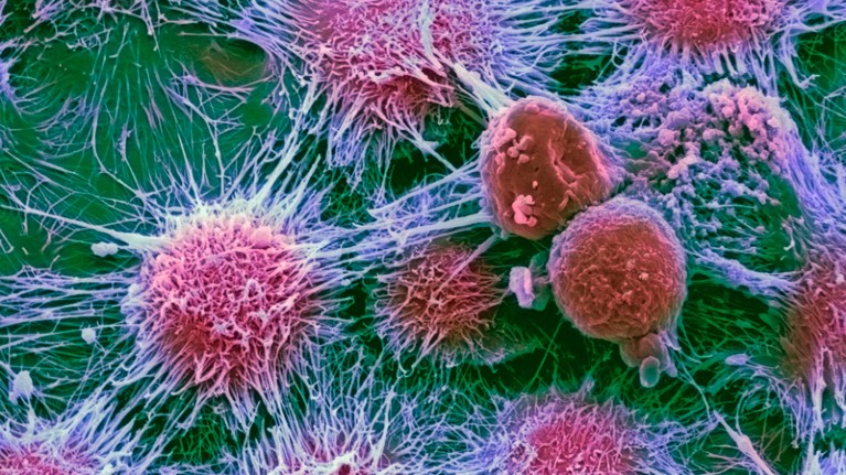 Coloured scanning electron micrograph of cancer cells from a kidney tumour.