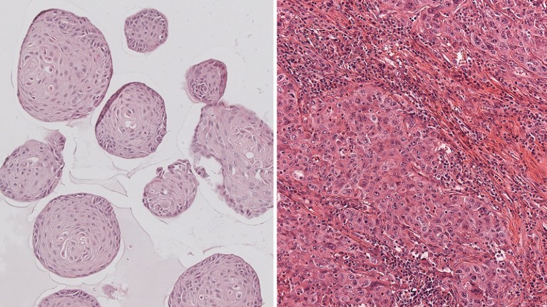 Tumor organoids and original tumor tissue