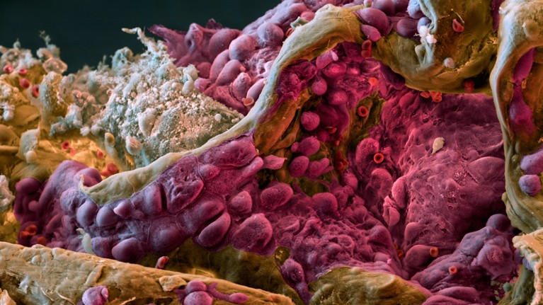 Micrograph of lung tissue affected by cancer