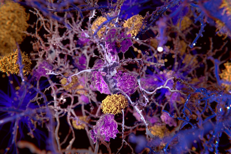 Computer illustration of amyloid plaques amongst neurons