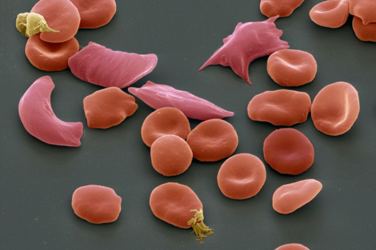 Scanning electron micrograph of normal red blood cells and distorted sickle-shaped cells in sickle cell anaemia
