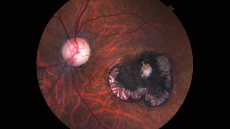 Retinal scar caused by a Toxoplasma gondii infection, or toxoplasmosis.