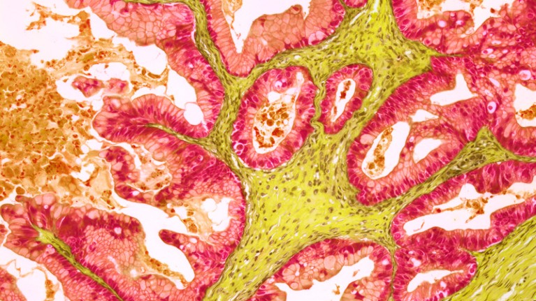 Ovarian tumour, light micrograph.