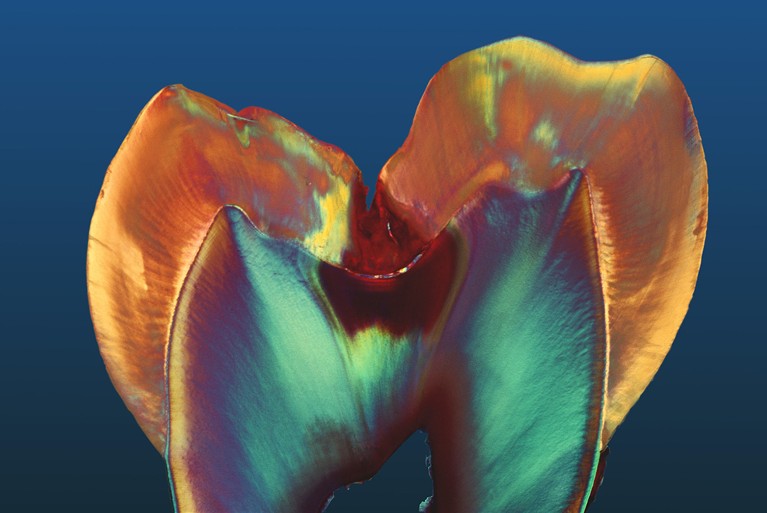 Colourful light micrograph of a molar tooth displaying signs of tooth decay