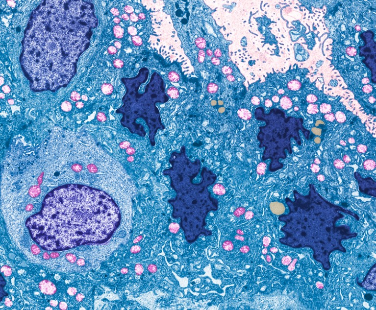 Coloured transmission electron micrograph of a section through a ductal carcinoma of the breast