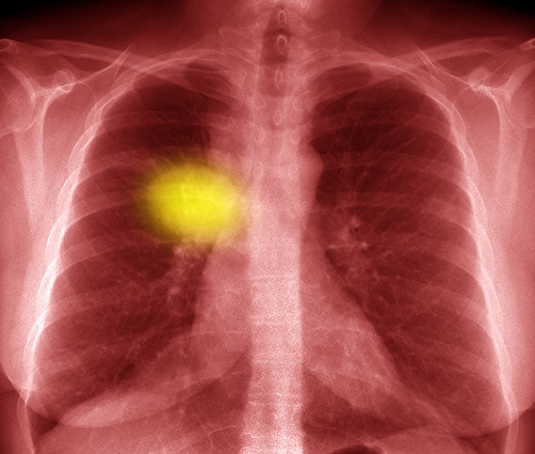 Frontal view of a coloured chest X-ray of a patient with adenocarcinoma of the right lung, shown as a yellow mass.