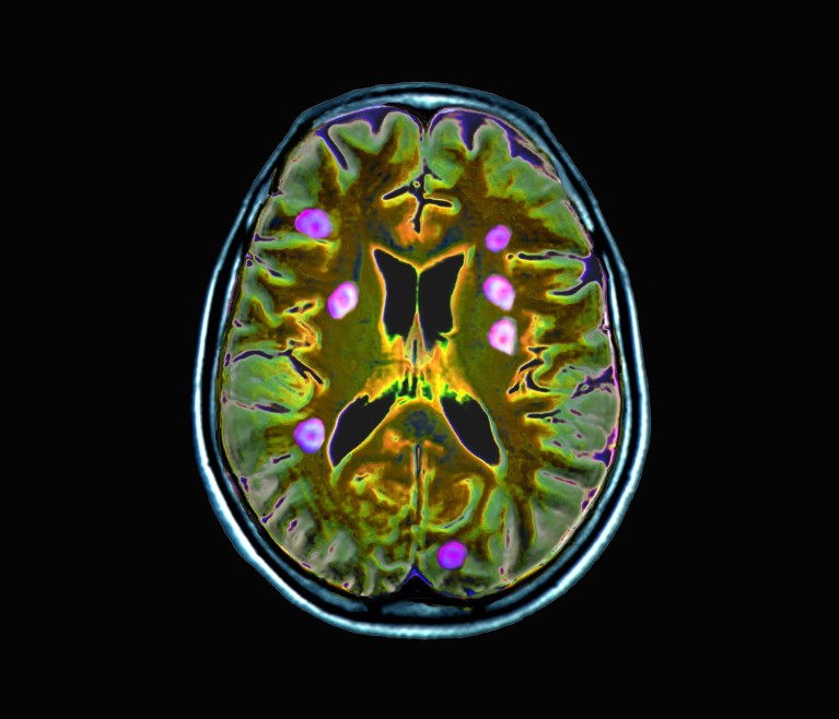 Coloured axial MRI scan through a brain with metastatic brain cancer
