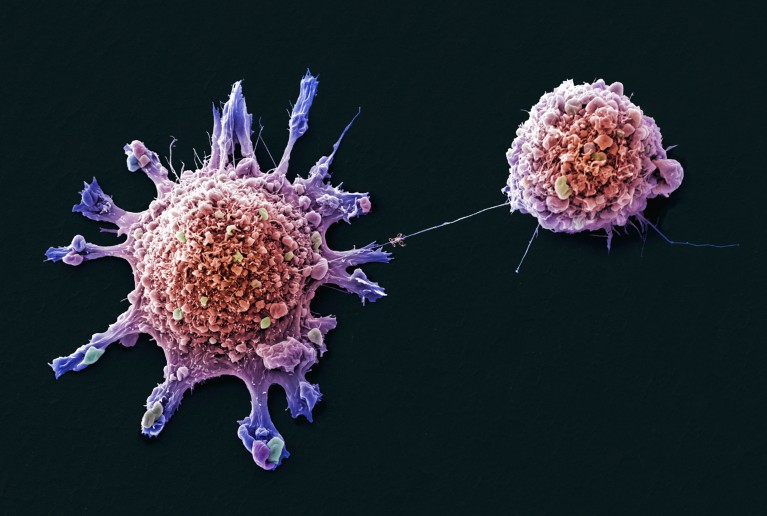 Coloured scanning electron micrograph of breast cancer cells