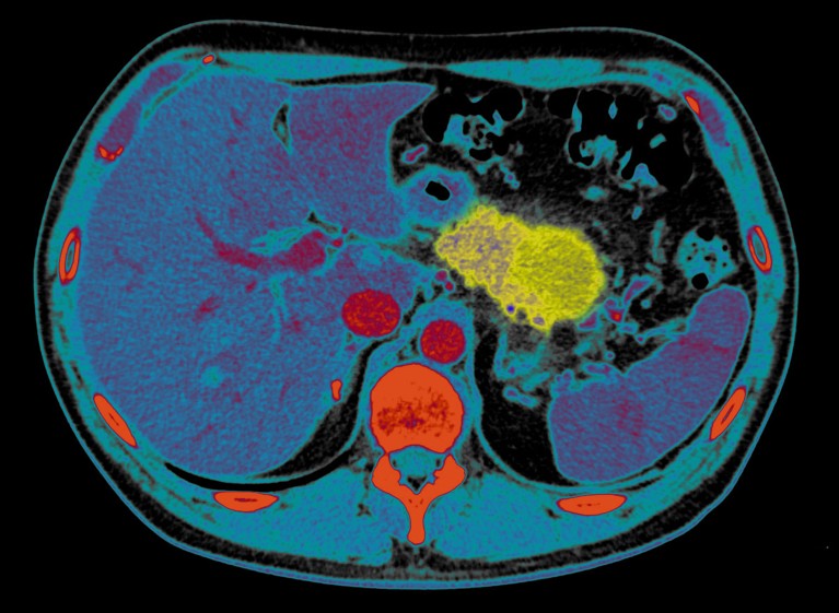 Coloured CT scan of the abdomen of a patient with pancreatic cancer