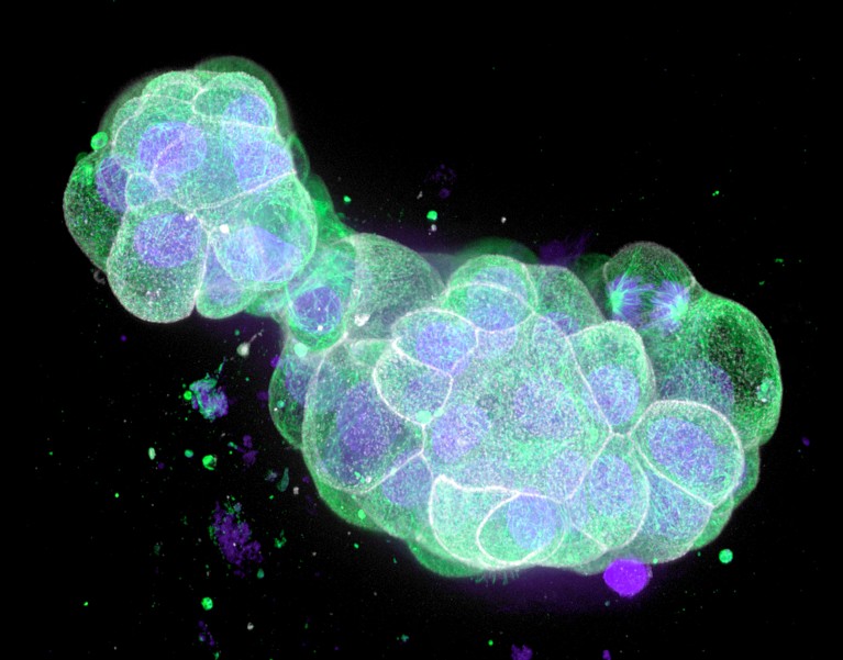 Three-dimensional fluorescence micrograph of human colon cancer cells in green and purple colours