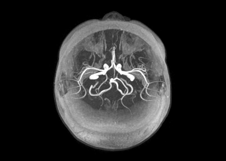 27个月大的婴儿癫痫发作后的大脑磁共振血管造影