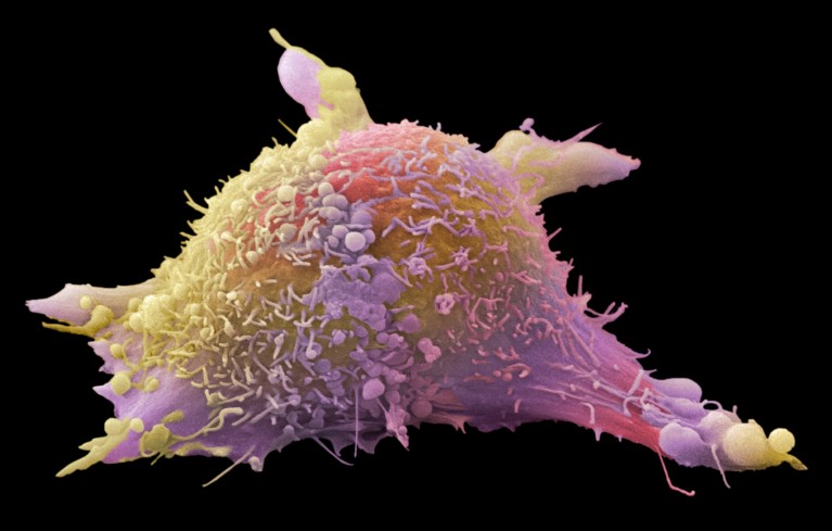 Coloured scanning electron micrograph of a cultured melanoma cell