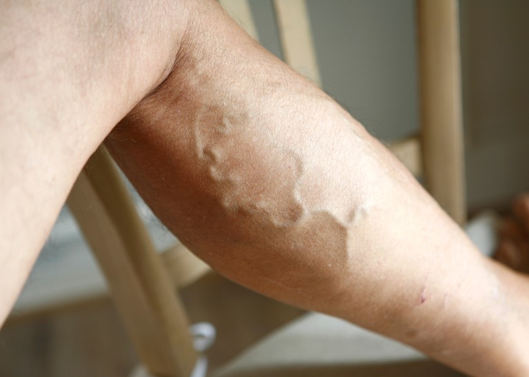 Varicose vein on the lower back half of a leg
