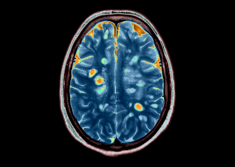 Coloured axial MRI scan of the brain of a patient with multiple sclerosis