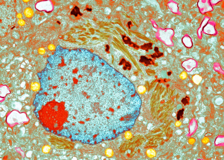 Coloured transmission electron micrograph of a neuron in Alzheimer's disease