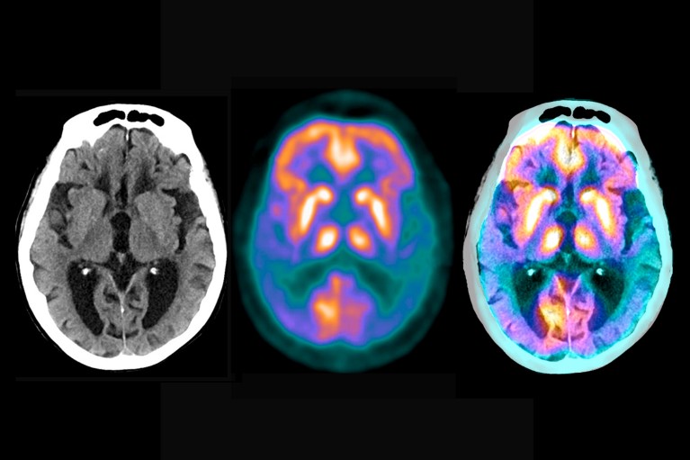 A triptych of three brain scans from a patient with Alzheimer's disease on a black background