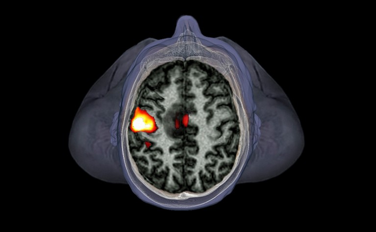 fMRI scan of a 39 year old man with a malignant tumour in the left hemisphere of the brain.