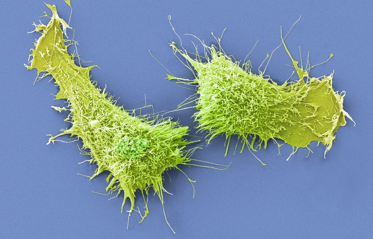 Cervical cancer cells, coloured scanning electron micrograph (SEM).