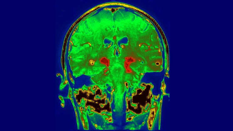 Magnetic resonance image (MRI) of Parkinson's Disease in the human brain.