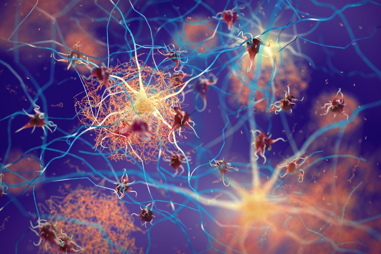 An illustration of neurons surrounded by tangles of amyloid plaques in the brain of a person with Alzheimer's disease