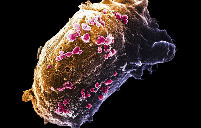 Scanning electron micrograph of a lymphocyte with HIV cluster.