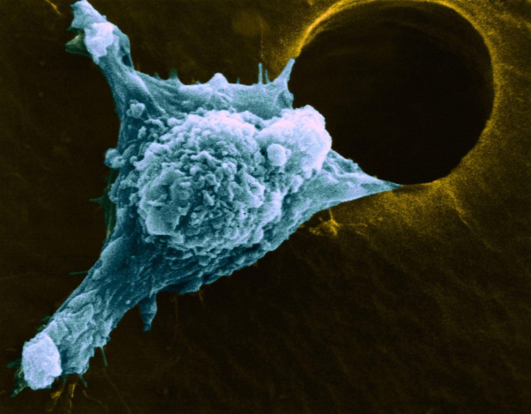 Colored scanning electron micrograph (SEM) of a cultured cancer cell moving (metastasizing) through a hole in a support film.