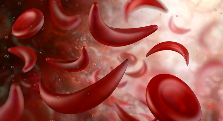 An illustration of sickle cell anaemia, showing normal and crescent shaped red blood cells flowing through a blood vessel
