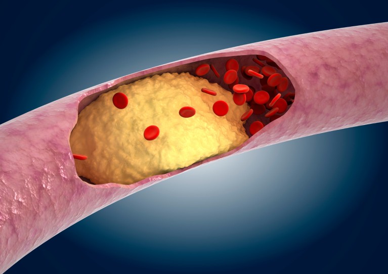 A cutaway computer artwork showing the interior of an artery affected by yellow atherosclerosis, with red blood cells struggling to pass through.