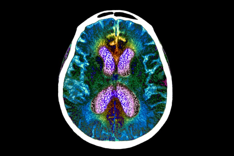 A CT scan of a patient’s brain with Alzheimer's disease, showing internal structures in blue, purple and yellow colours against a black background