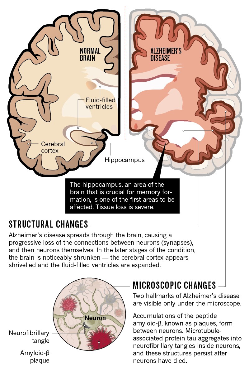 normal optical pathological aging