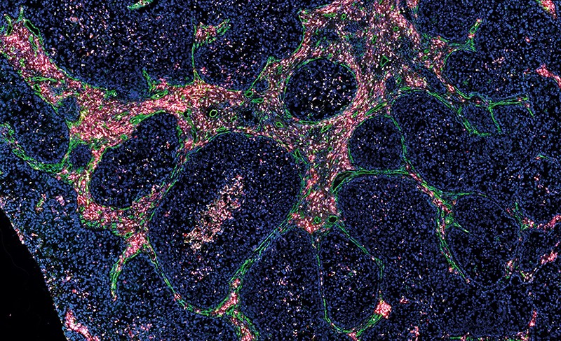 Blood vessels in a secondary brain tumour