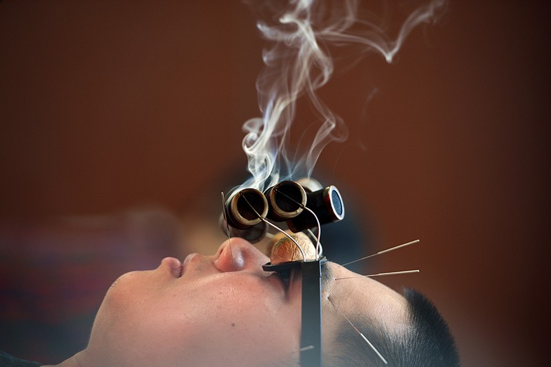 A man wearing 'walnut' glasses is treated with smoking wormwood to relieve his oculomotor paralysis.