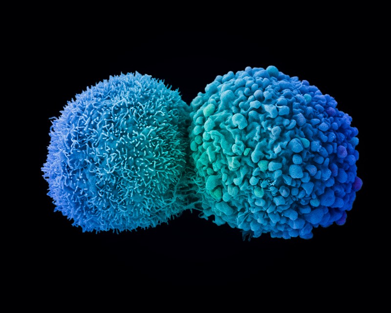 Lung cancer cells dividing, coloured scanning electron micrograph (SEM).